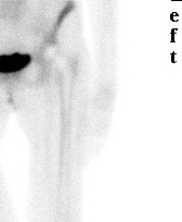 THR Bone Scan Normal